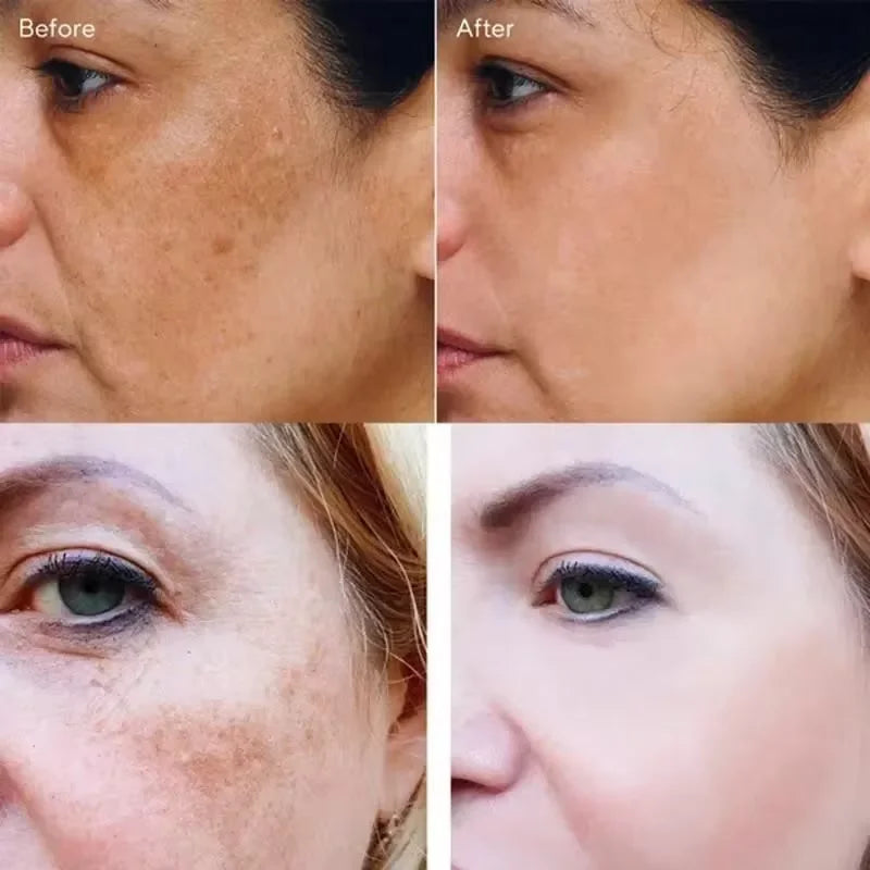Vitamin C Whitening Freckles Face Cream Remove Melasma Dark Spots Lighten Melanin Acne Scar Anti-aging Brighten Face Skin Care